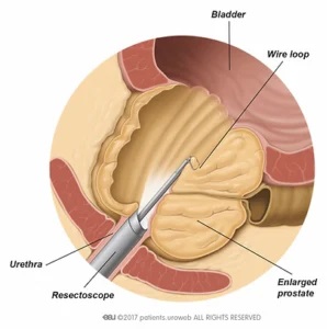 Tratamiento de la hiperplasia