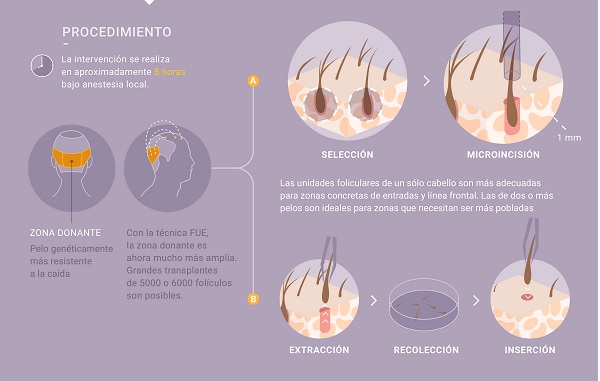 Procedimiento FUE con CEME