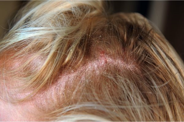 Persona con problemas de dermatitis en la piel