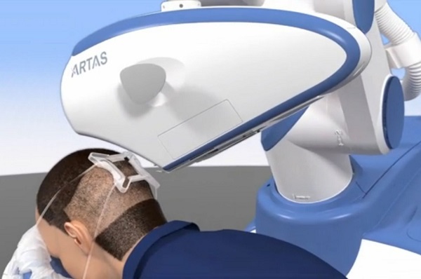 Robot ARTAS para el trasplante capilar FUE