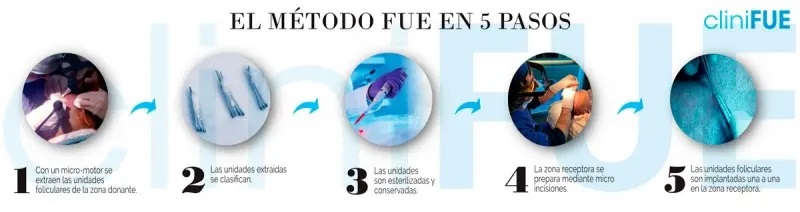 Técnica FUE paso a paso con CliniFUE