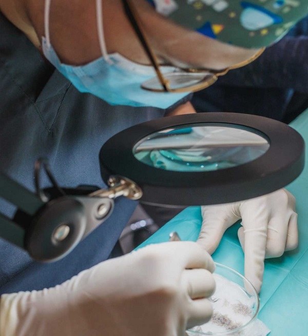 Técnicas de trasplante capilar con Adcure