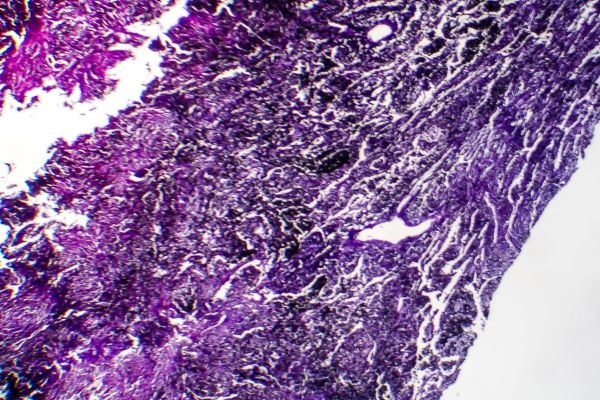 Silicosis al microscopio