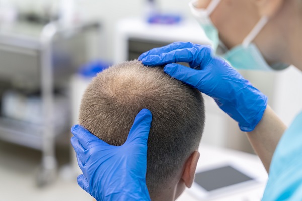 Diagnóstico alopecia areata