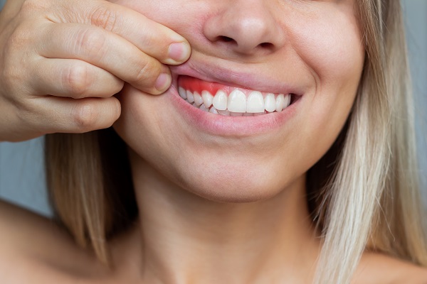 Los síntomas de la gingivitis