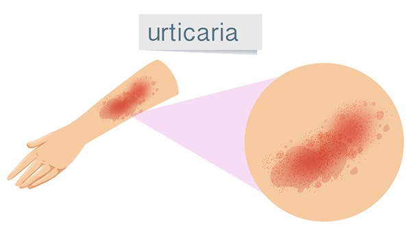 Brazo con urticaria