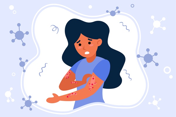 Persona sufriendo de urticaria rascándose el brazo